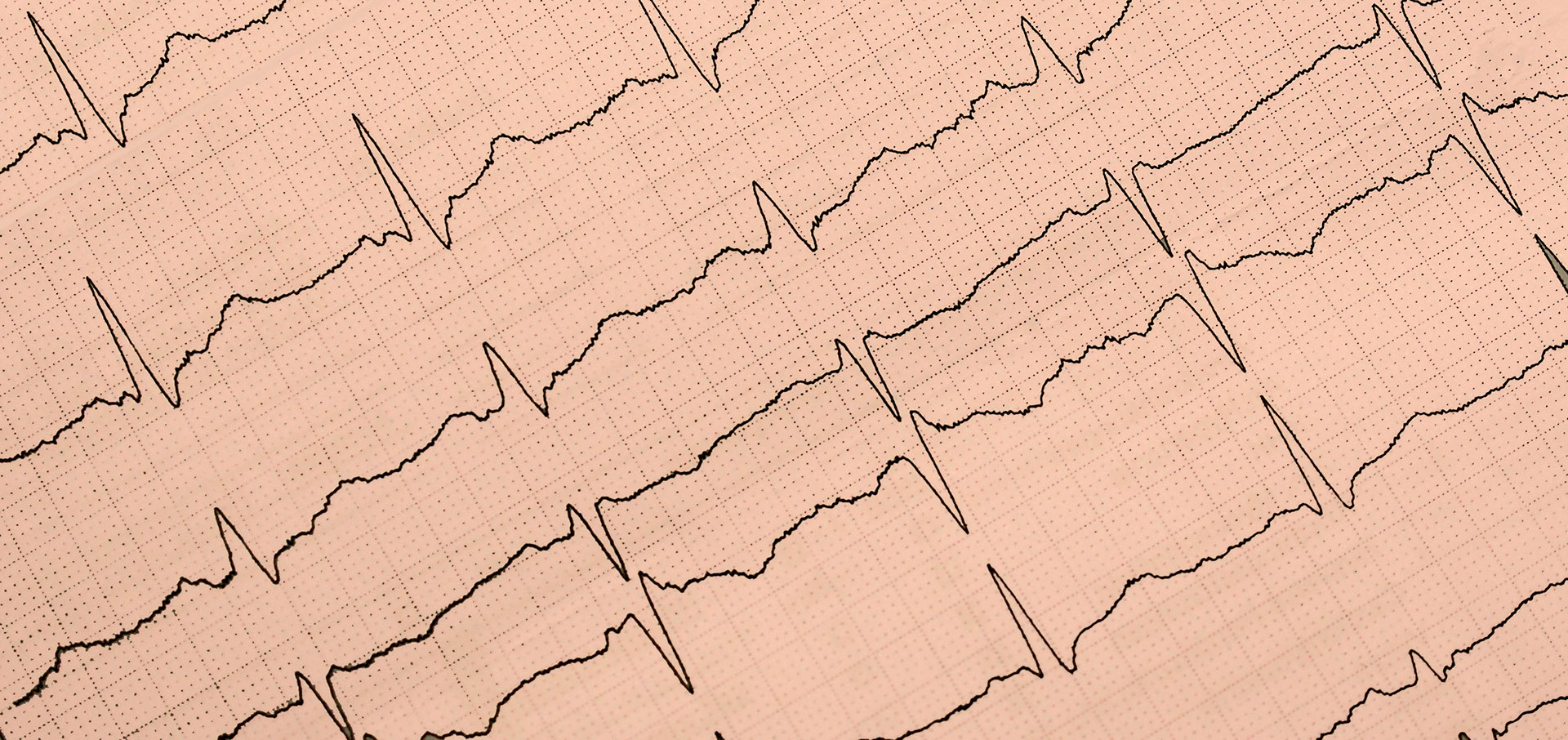 Darstellung eines Elektrokardiogramm (EKG)